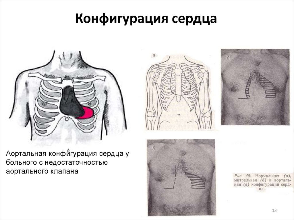 Аортальное сердце. Конфигурация сердца при митральной недостаточности. Митральная и аортальная конфигурация сердца. Конфигурация сердца в норме и при патологии. Конфигурации сердца пропедевтика.