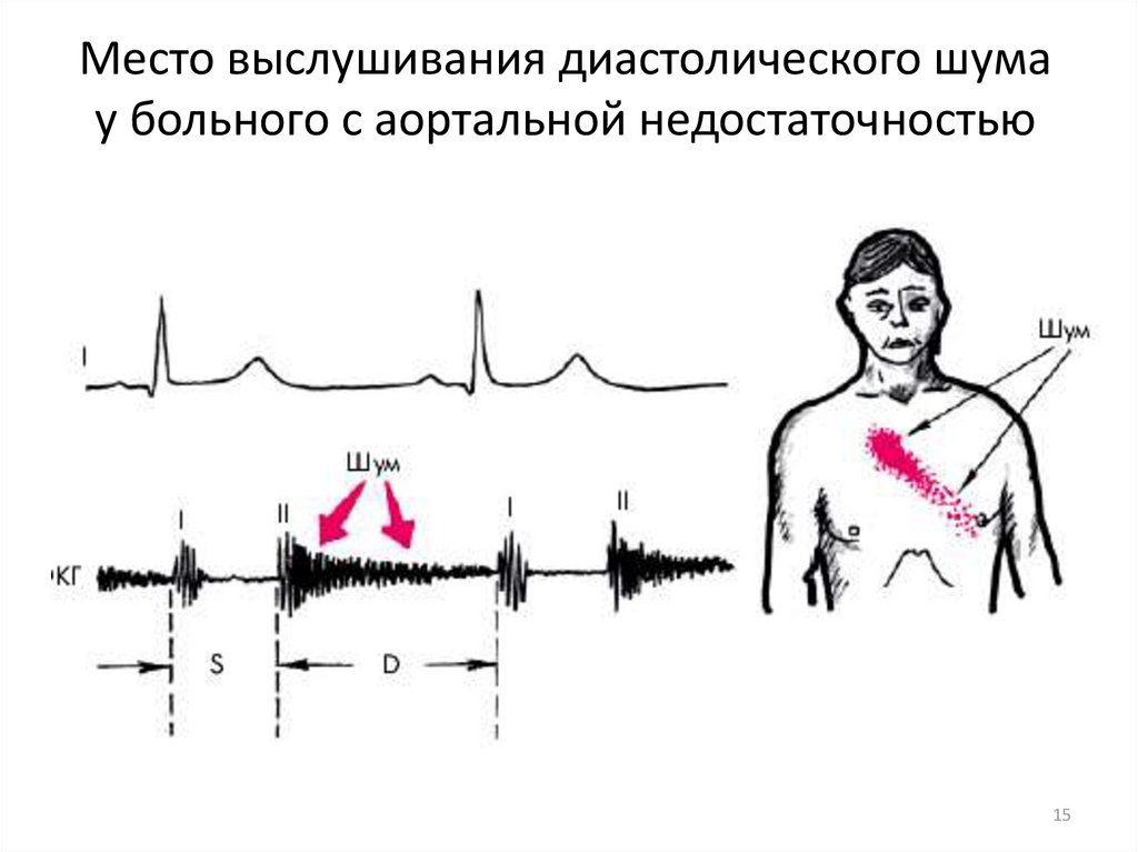Место выслушивания диастолического шума у больного с аортальной недостаточностью