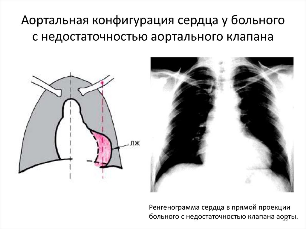 Аортальная конфигурация сердца у больного с недостаточностью аортального клапана