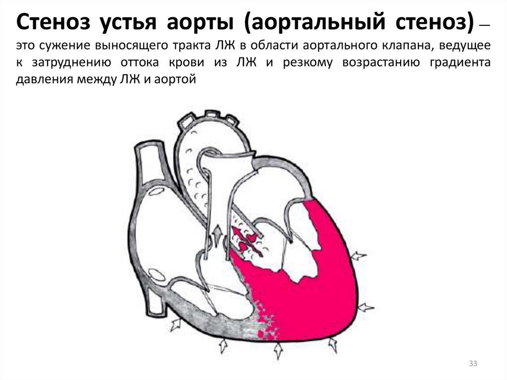 Стеноз устья аорты (аортальный стеноз) — это сужение выносящего тракта ЛЖ в области аортального клапана, ведущее к затруднению