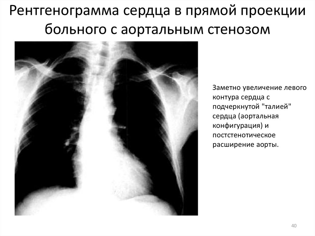 Рентгенограмма сердца в прямой проекции больного с аортальным стенозом