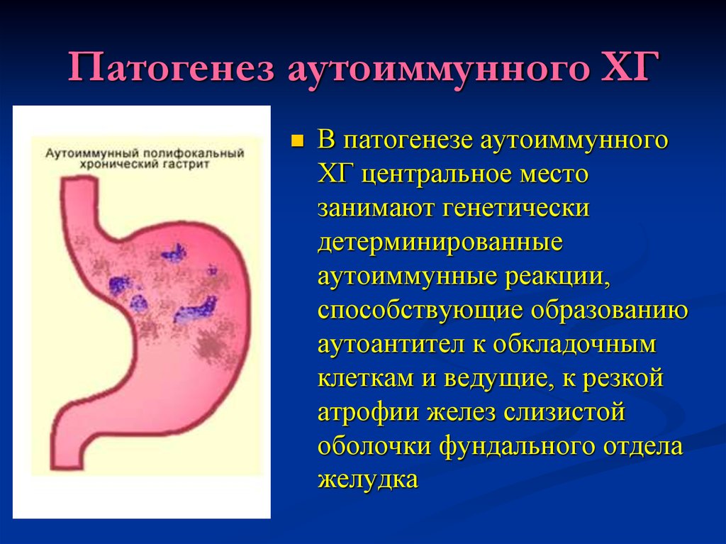 Причина гастрита б. Хронический аутоиммунный гастрит патогенез. Патогенез аутоиммунный аутоиммунного гастрита. Аутоиммунный гастрит этиология. Аутоиммунный атрофический гастрит.