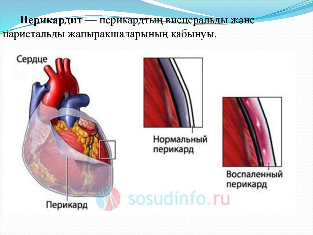 Перикард что это простыми словами. Синдром Дресслера перикардит. Воспаление околосердечной сумки.