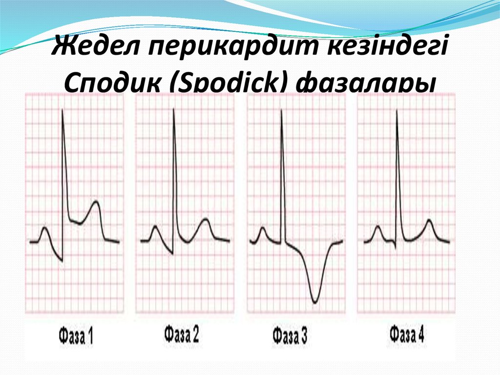 Перикардит экг картина