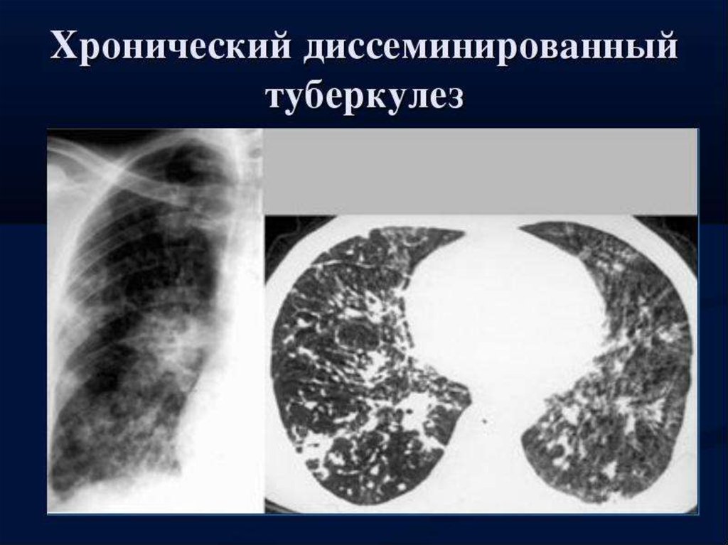 Лимфогенный туберкулез. Острый диссеминированный туберкулез рентген. Диссеминированный туберкулёз лёгких рентген. Подострый диссеминированный туберкулез рентген. Гематогенно диссеминированный туберкулез рентген.