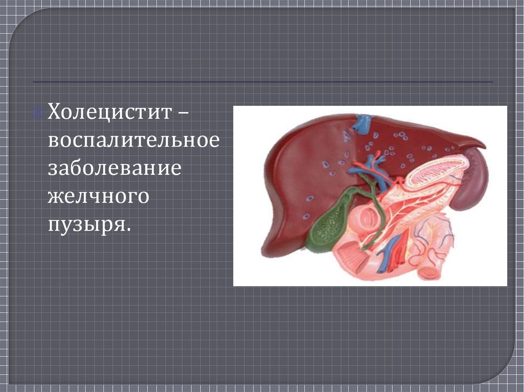 Холецистит что это. Холецистит желчного пузыря. Хронический холецистит презентация. Острый и хронический холецистит презентация. Патологии желчного пузыря.