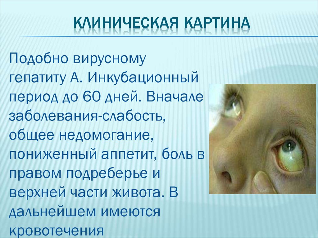 Клиническая картина гепатита а