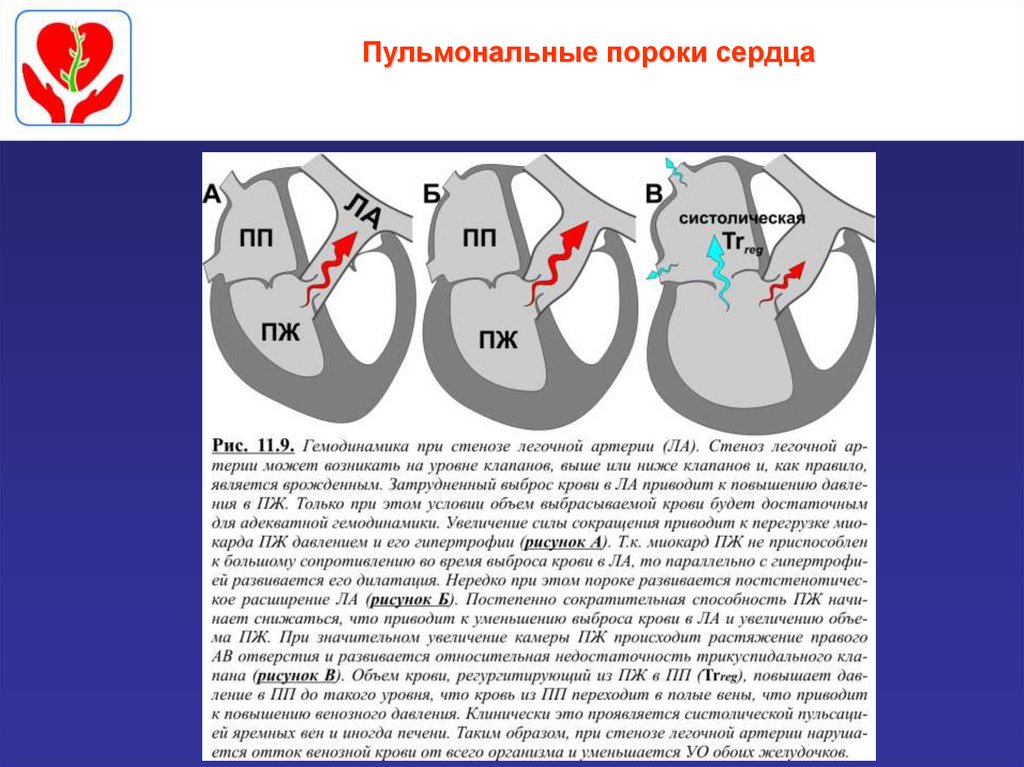 Аускультативная картина при митральном стенозе сердца включает