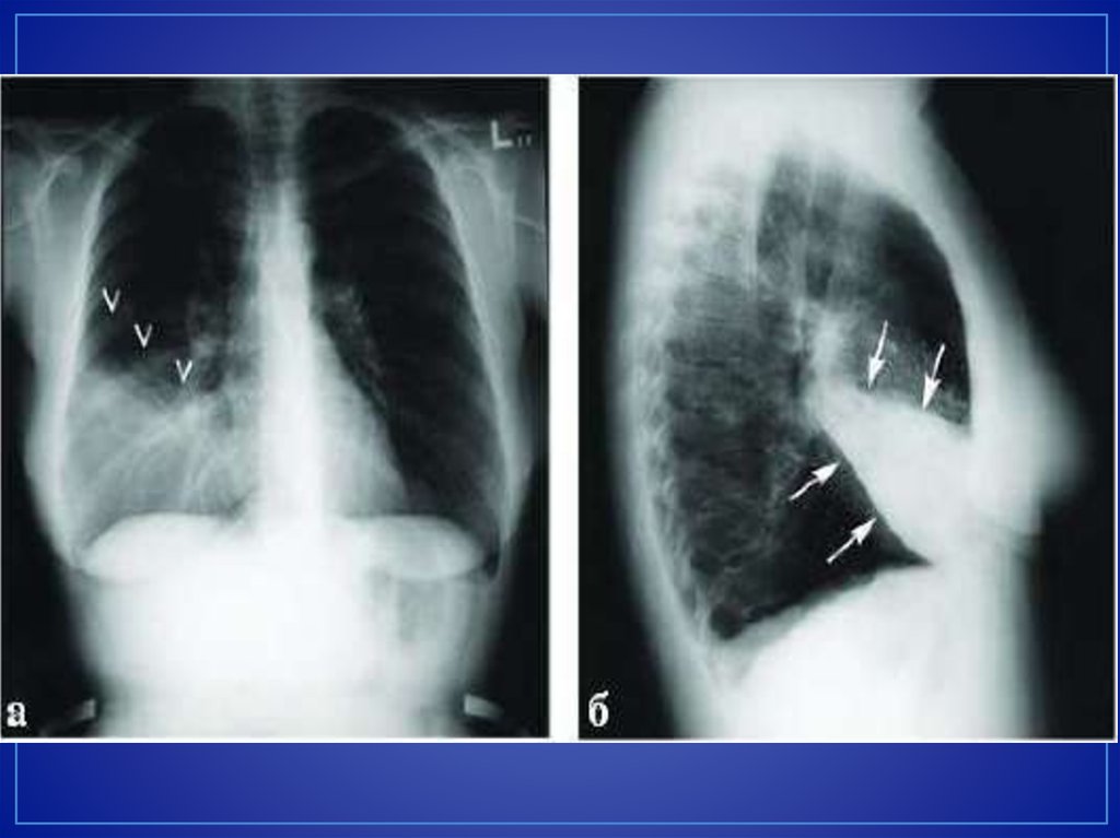 Пневмония в правом легком в нижней доле. Крупозная пневмония рентген. Крупозная пневмония рентген снимок. Правосторонняя среднедолевая пневмония рентген. Долевая крупозная пневмония рентген.