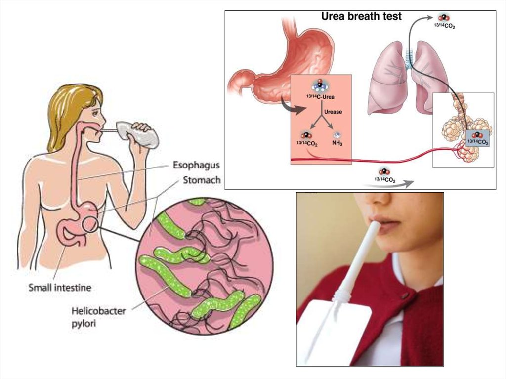 Дыхательный тест желудка
