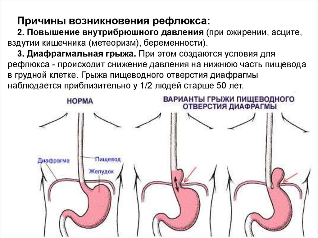 Грыжа пищеводного отверстия симптомы лечение