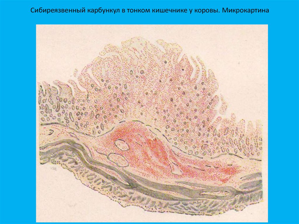 Туберкулезный менингит микропрепарат рисунок