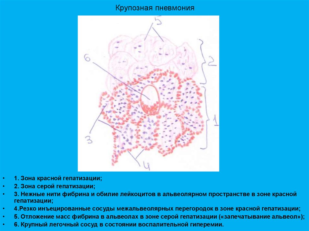 Крупозная пневмония рисунок