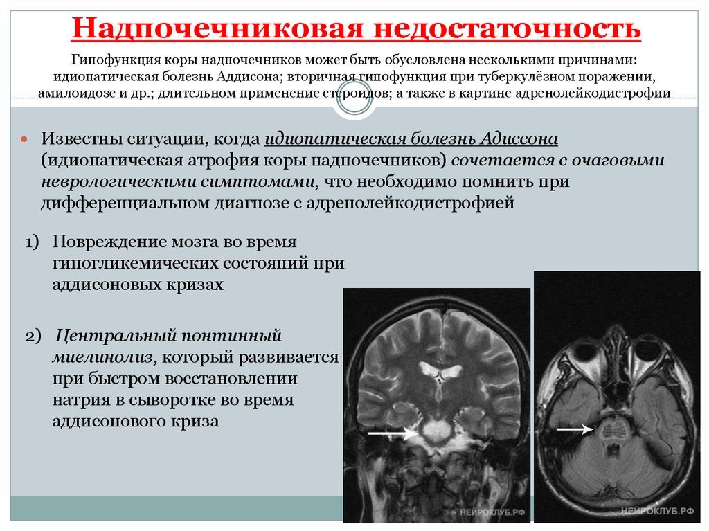 Диагностика коры надпочечников