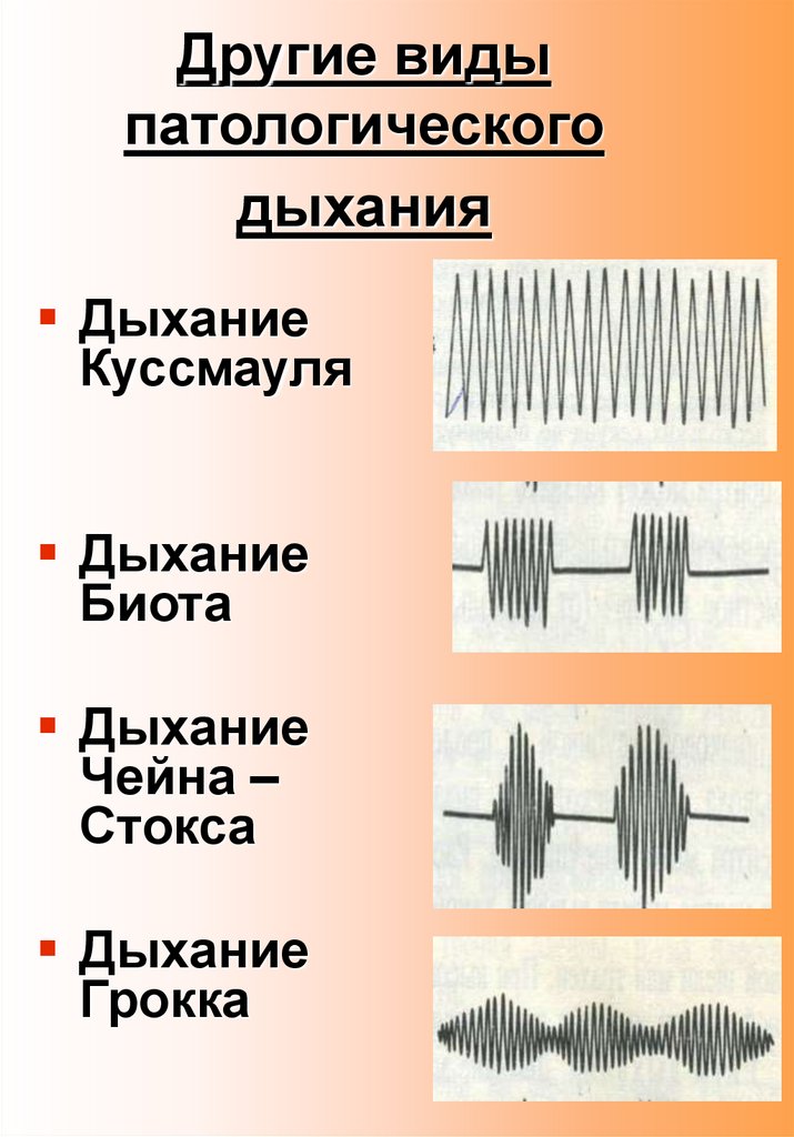 Патологическое дыхание. Дыхание Биота Чейна Стокса Куссмауля. Тип дыхания Грокка. Патологические типы дыхания у человека. Патологические типы дыхания схема.