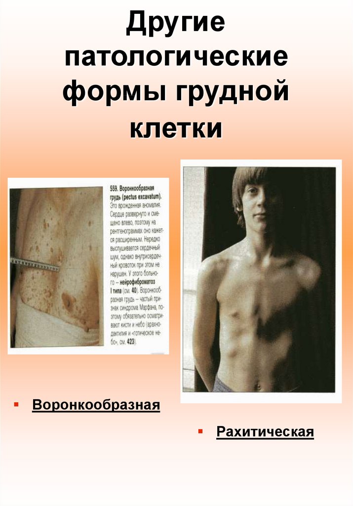 Другие патологические формы грудной клетки