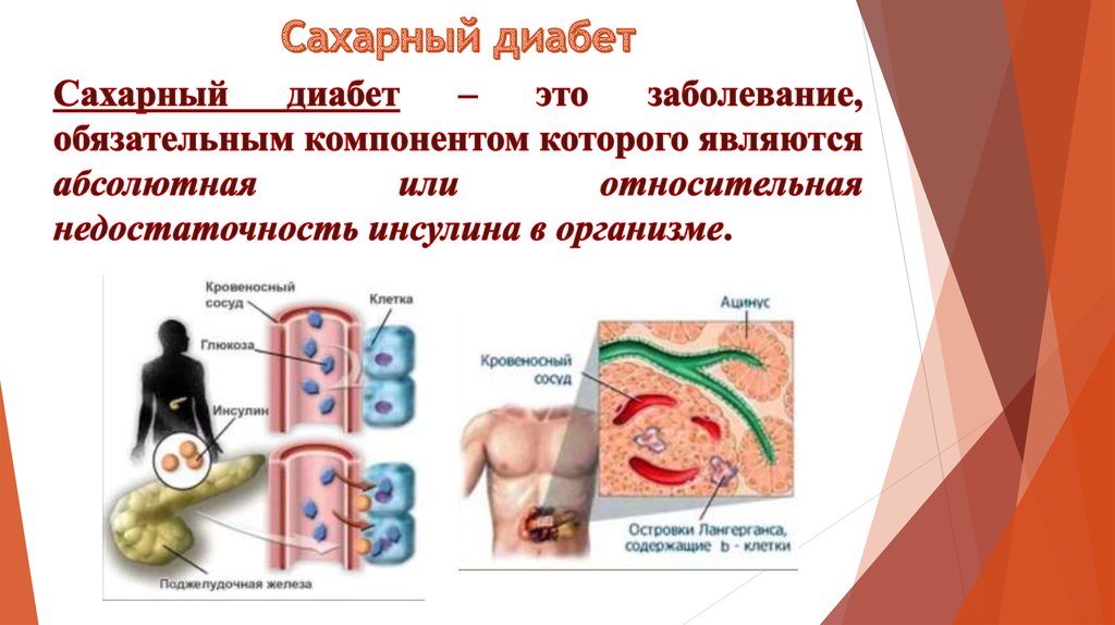 Кандли диабет презентация