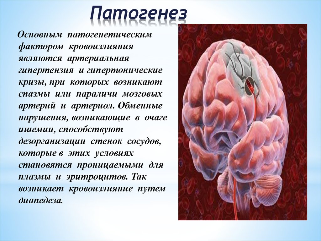 Геморрагический инсульт тесты с ответами