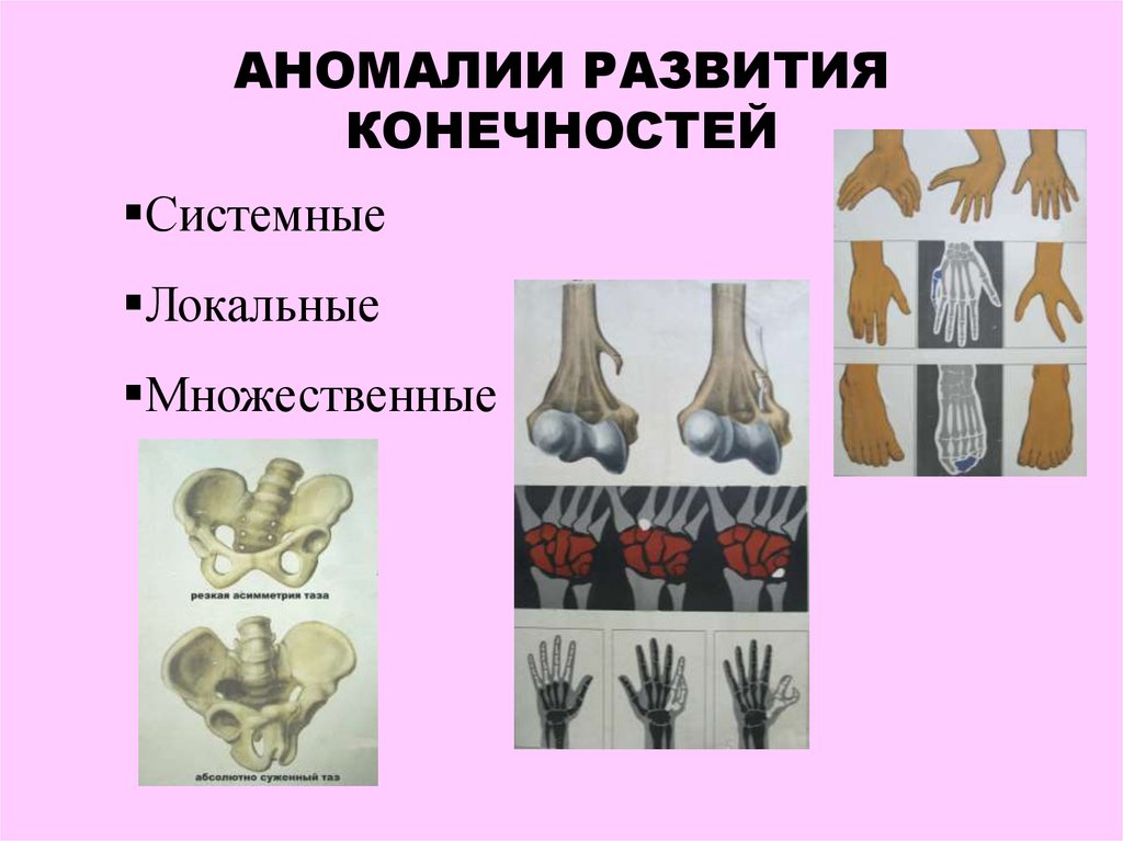 Аномалии развития костей