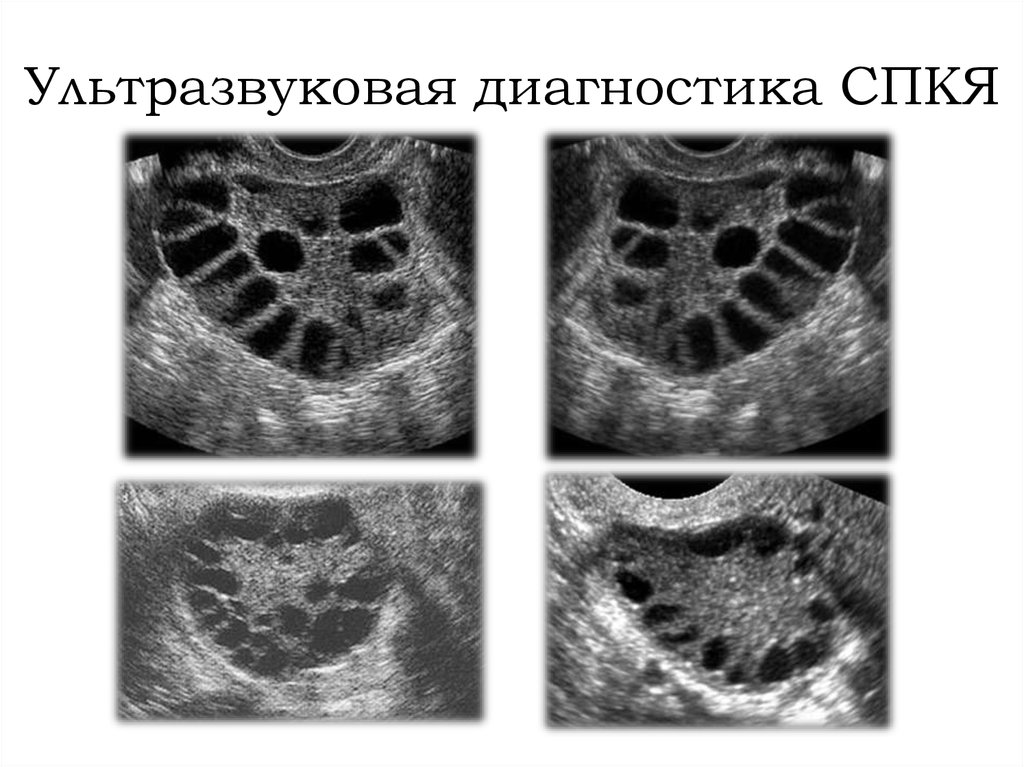 Овуляция при поликистозе. Синдром поликистоза яичников на УЗИ. УЗИ мультифолликулярных яичников. Снимок УЗИ поликистоз яичников.