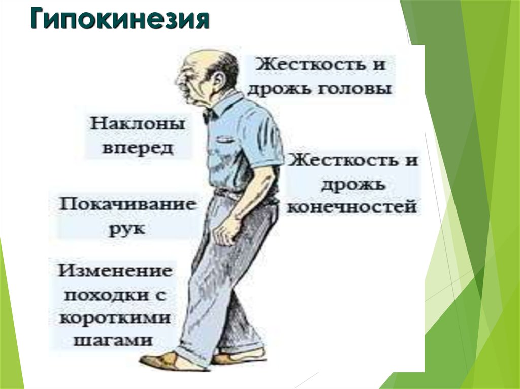 Гипокинезия это. Гипокинезия. Гипокинезия характеризуется. Гипокинезия люди. Гипокинезия картинки.