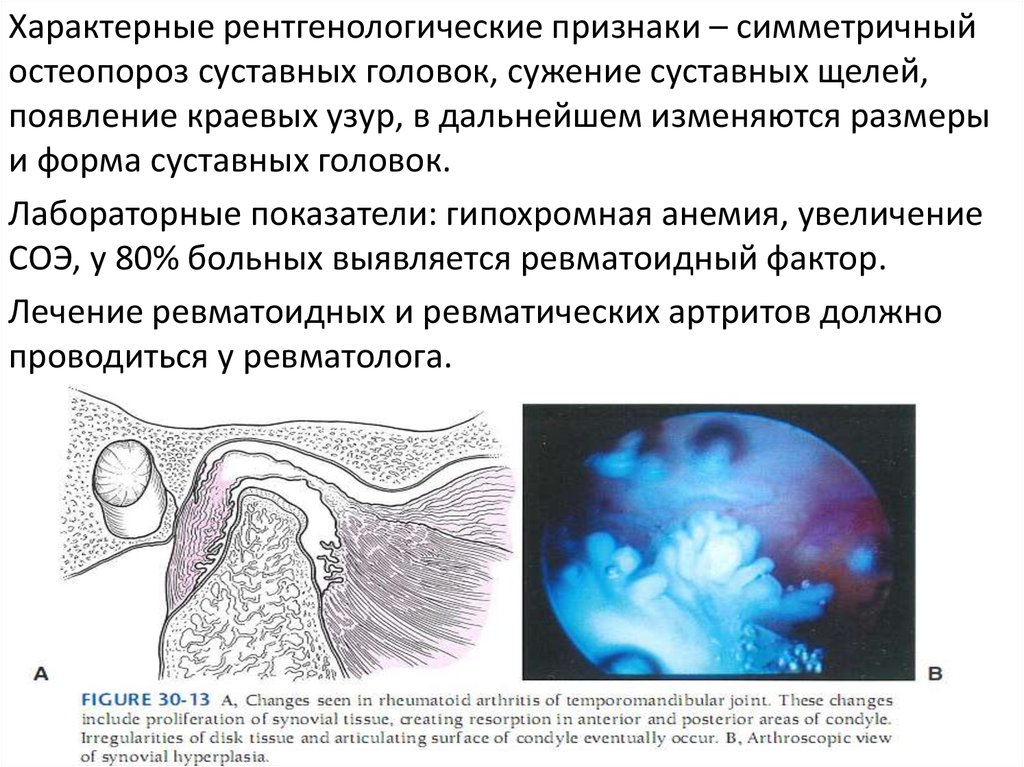 Внчс симптомы. Ревматоидный артрит ВНЧС кт. Ревматоидный артрит височно-нижнечелюстного сустава. Рентгенологическая картина при хронических артритах ВНЧС. Характерные рентгенологические признаки.