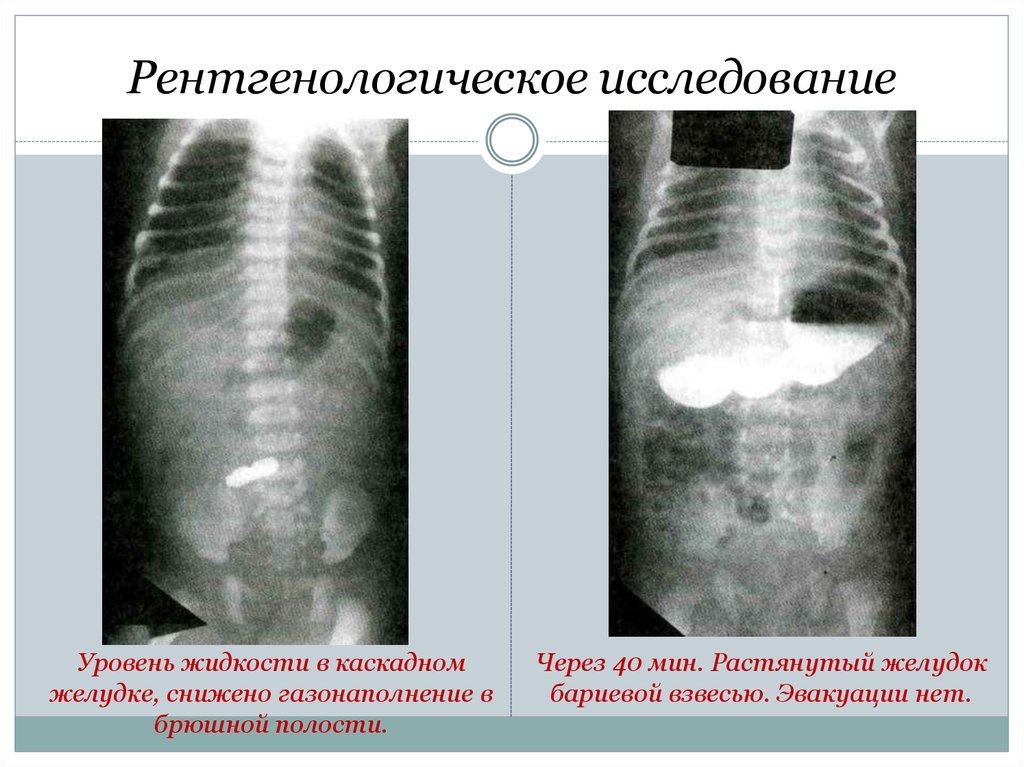 Врожденный пилоростеноз презентация