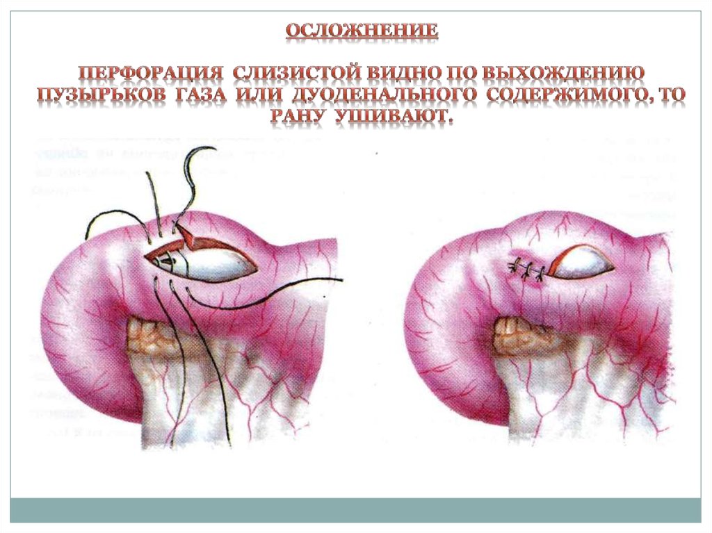 Пилоростеноз - презентация онлайн