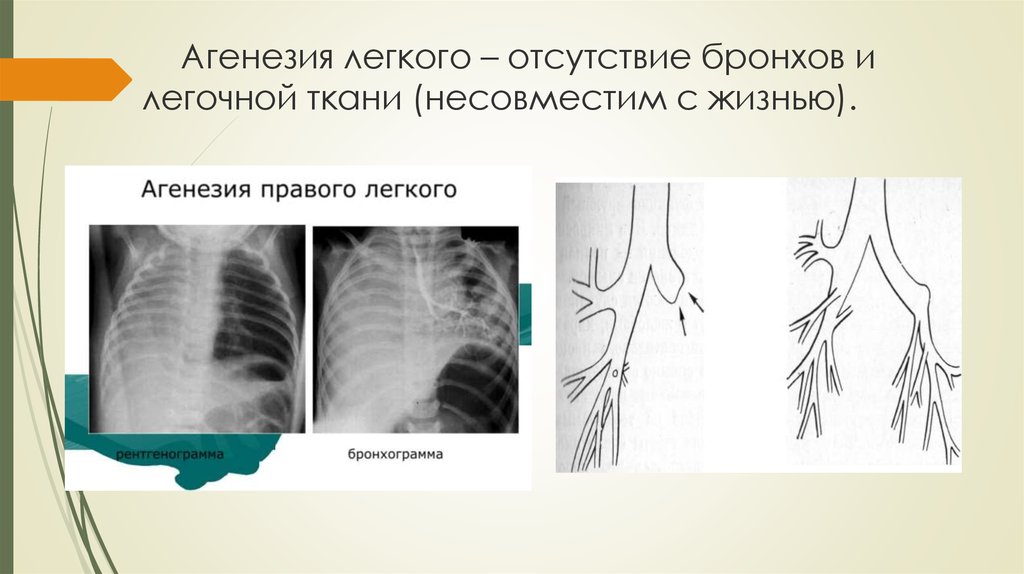 Гипоплазия легкого презентация