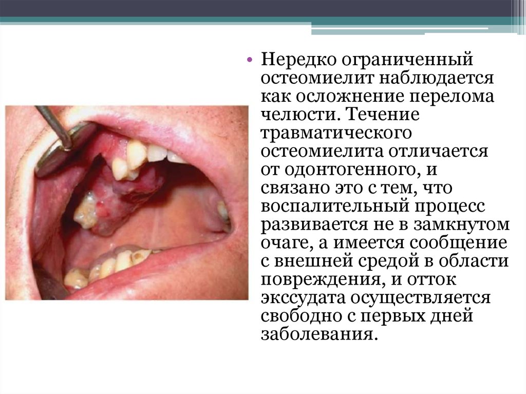 Остеомиелит нижней челюсти фото