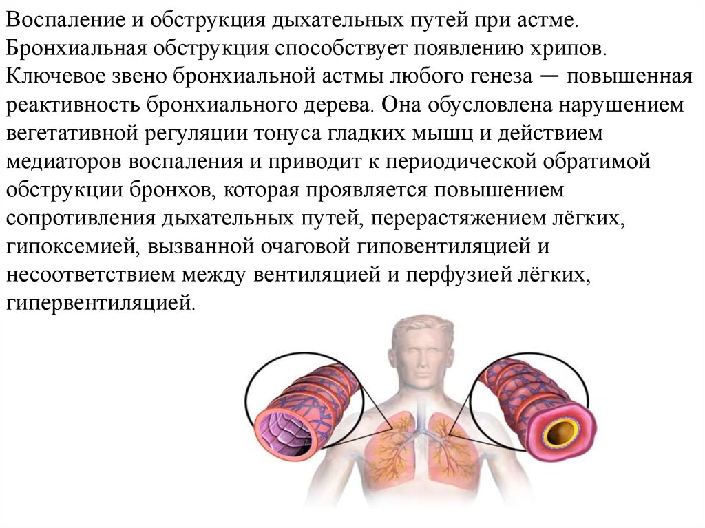 Воспаление тест. Обструкция дыхательных путей при бронхиальной астме. Бронхиальная обструкция при бронхиальной астме. Воспаление дыхательных путей при бронхиальной астме. При обструкции дыхательных путей.