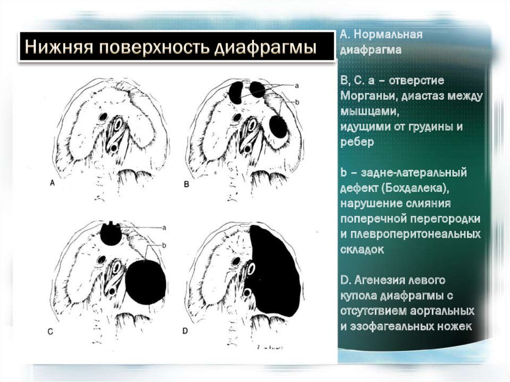 Грыжа бохдалека. Грыжи диафрагмы Бохдалека. Диафрагмальная грыжа Бохдалека справа. Грыжа Морганьи Ларрея на кт. Грыжи диафрагмы Богдалека на кт.