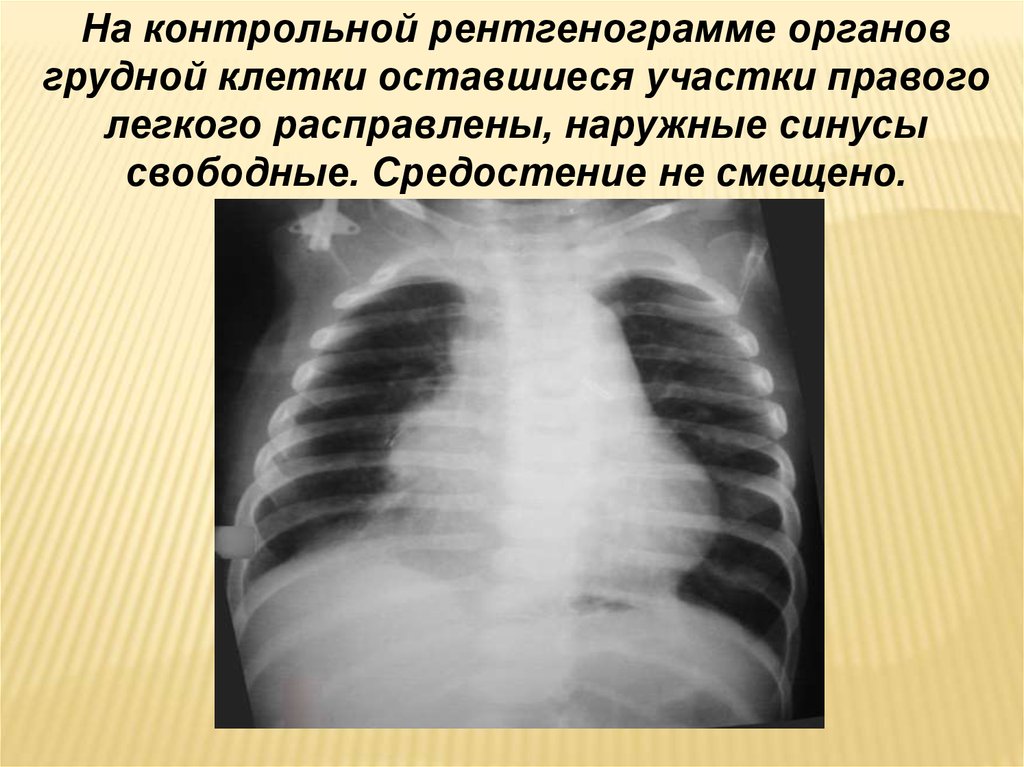 Легочные синусы свободны. Пороки развития органов грудной клетки. Синусы свободные в легких. Врожденная лобарная эмфизема.