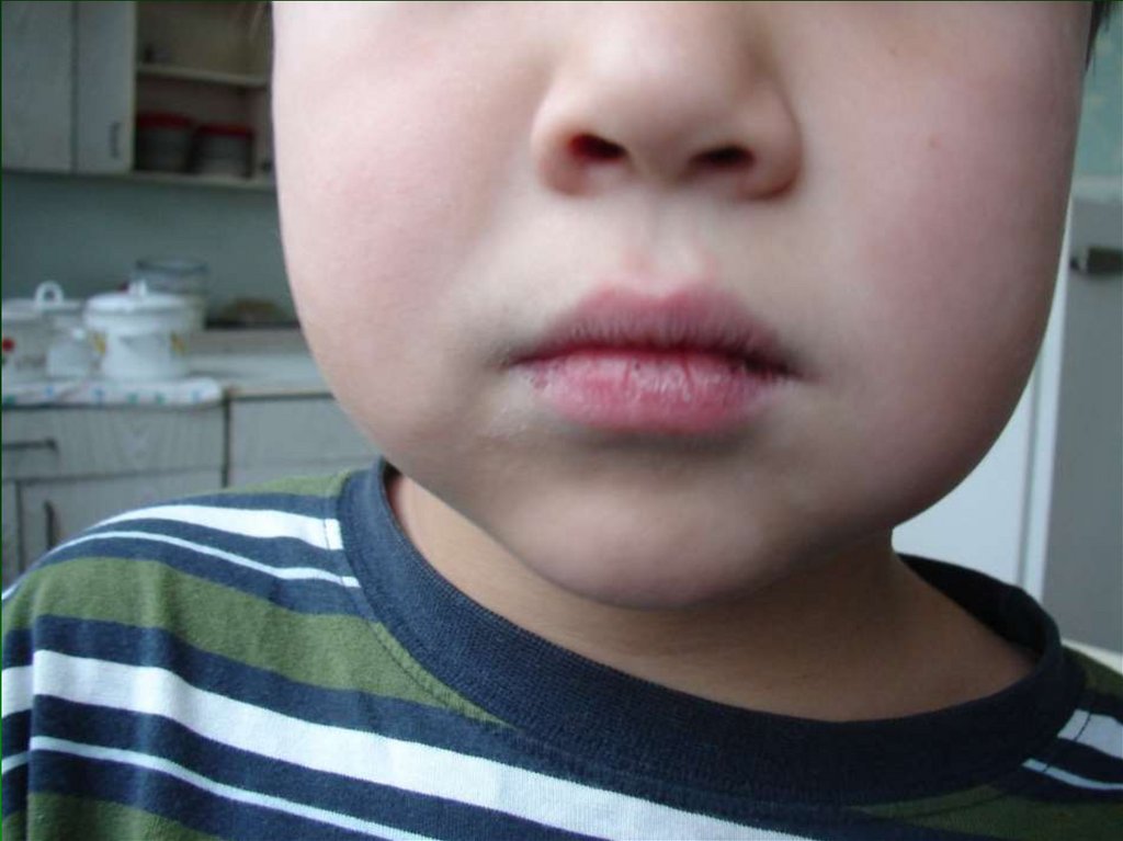 У ребенка болит щека. Периостит челюсти (флюс). Острый серозный периостит. Серозный периостит челюсти.