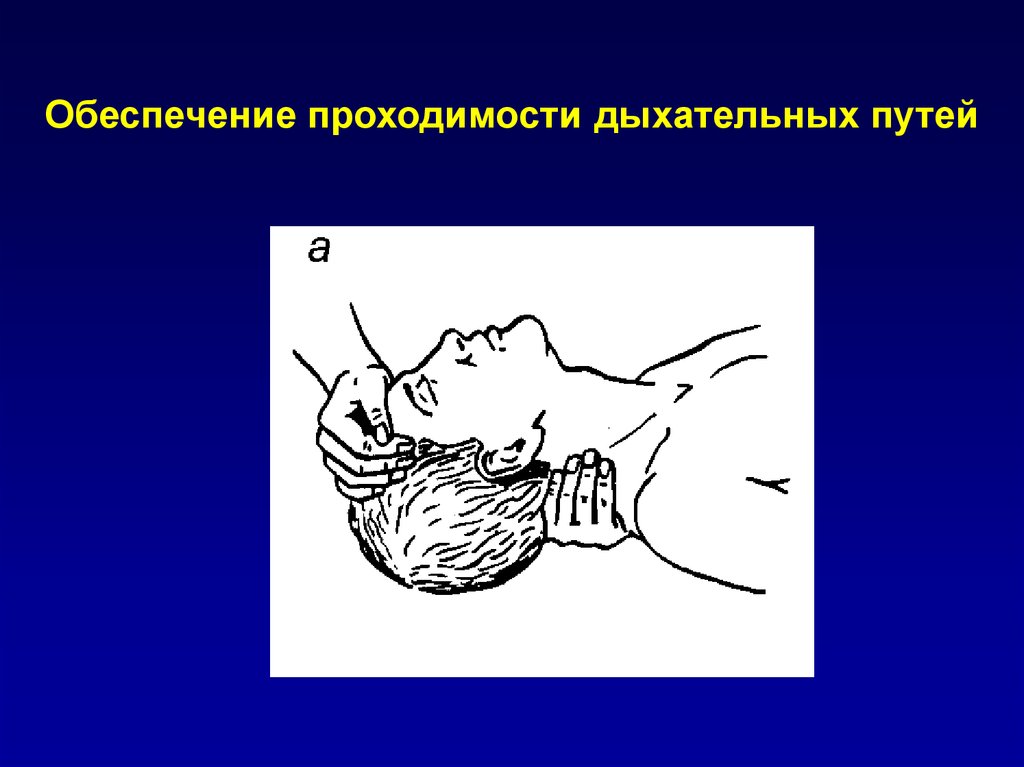 Проведение проходимости дыхательных путей. Обеспечение проходимости дыхательных путей. Приемы обеспечения проходимости дыхательных путей. Обеспечить проходимость дыхательных путей алгоритм. Проходимость дыхательных путей СЛР.