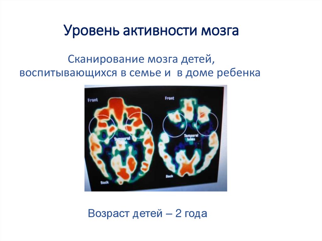 Уровень активности. 1 Атомарный уровень сканирование мозга. Низкая активность мозга у ребенка 2 года 3 балла. 5 Атомарный уровень сканирование мозга. Уровень активности мозга
