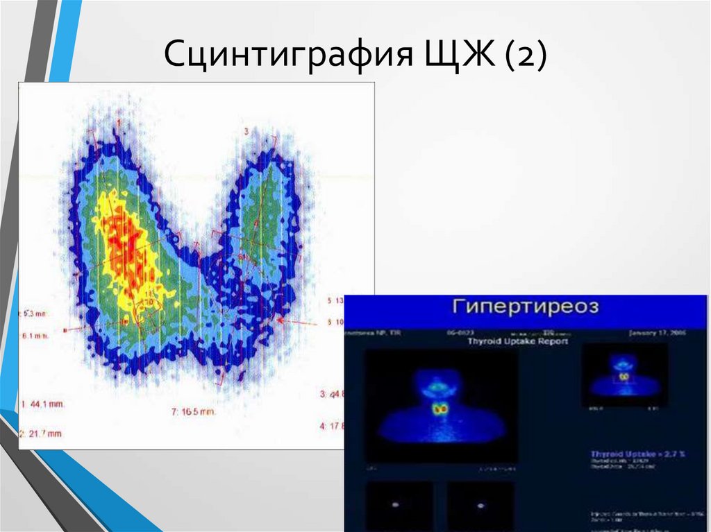 Что такое сцинтиграфия