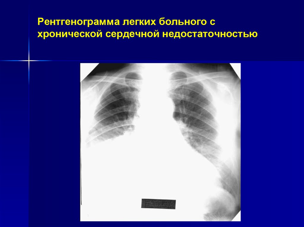 Недостаточность легких симптомы. Рентгенография грудной клетки при ХСН. Рентгенография грудной клетки при сердечной недостаточности. Рентгенография органов грудной клетки при ХСН.