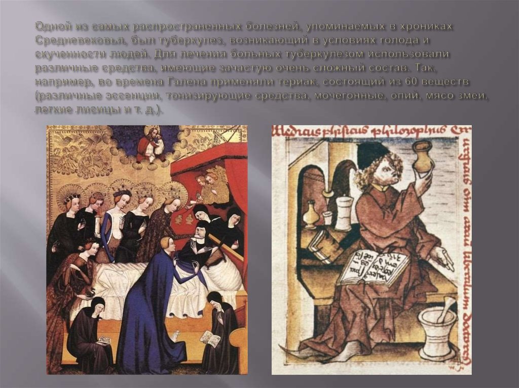 Одной из самых распространенных болезней, упоминаемых в хрониках Средневековья, был туберкулез, возникающий в условиях голода и