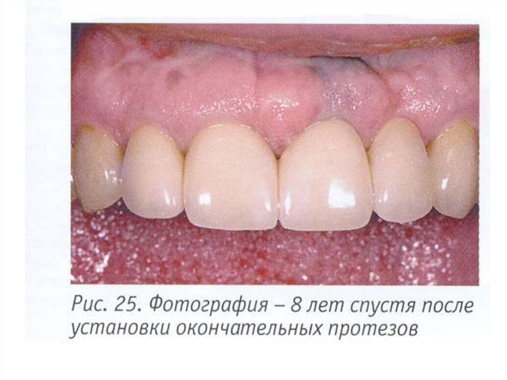 Керамические виниры презентация