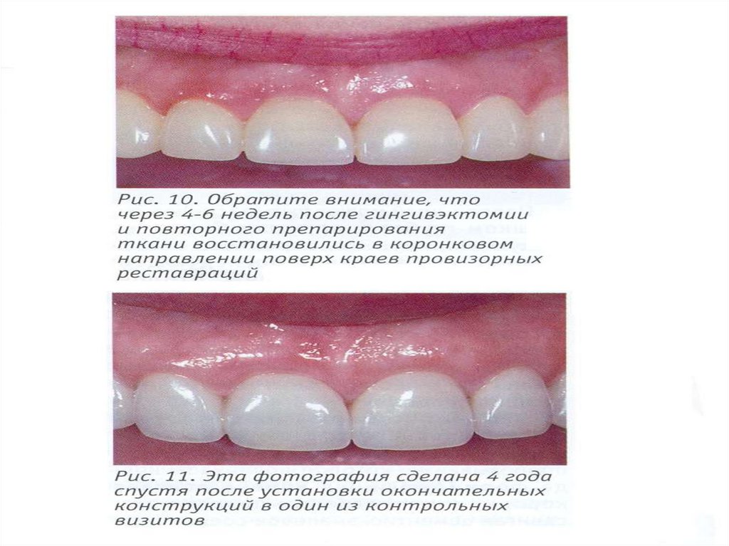 Керамические виниры презентация