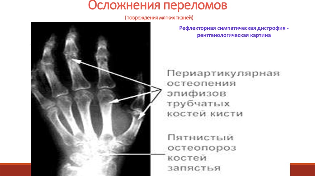 Возможное осложнение перелома. Осложнения переломов костей. Осложнения перелома руки.