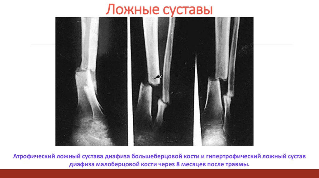 Ложный сустав рисунок