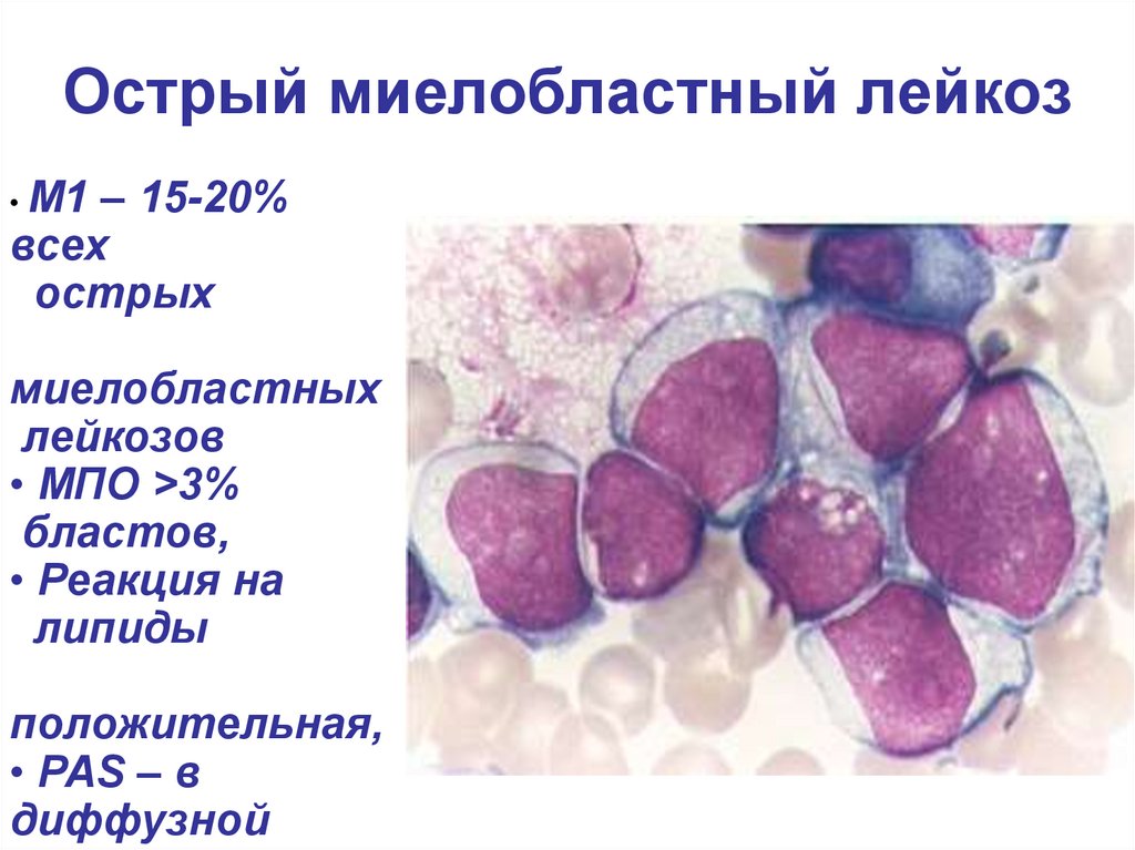 Острый миелоидный лейкоз прогноз. Острый миелобластный лейкоз вариант м1. Острый миелобластный лейкоз картина крови. Острый миелобластный лейкоз (м1-м2). Острый миелоидный лейкоз м5а вариант.