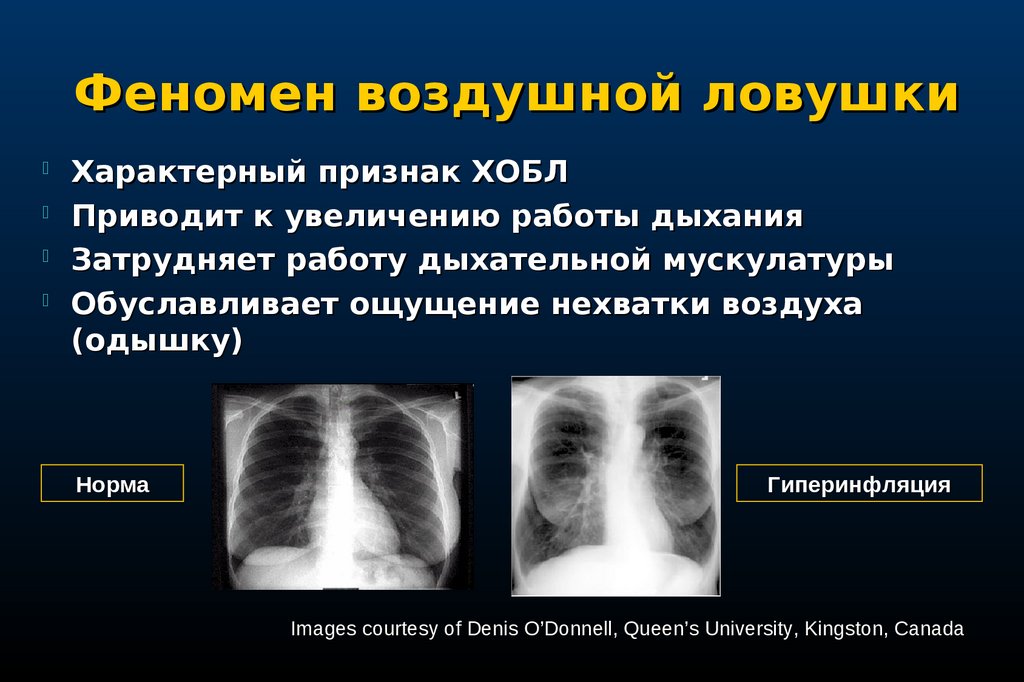 Лучевая диагностика хобл презентация