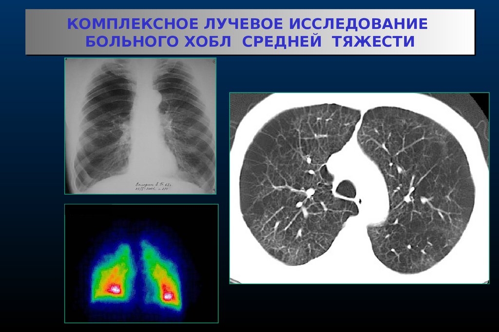 Бронхит хобл. Кт органов грудной клетки при ХОБЛ. Компьютерная томография при ХОБЛ. Кт при хроническом бронхите. Хронический обструктивный бронхит на кт.