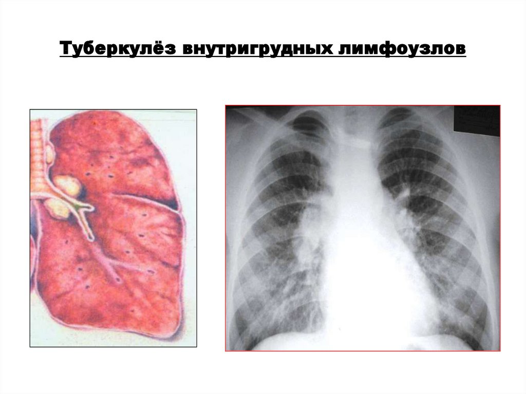 Врожденный туберкулез. Туберкулёз внутригрунных лимфатических узлов. Туберкулез внутригрудных лимфатических узлов инфильтративная форма. Туберкулез внутригрудных лимфатических узлов формы рентген. Туморозная форма туберкулеза внутригрудных лимфатических узлов.