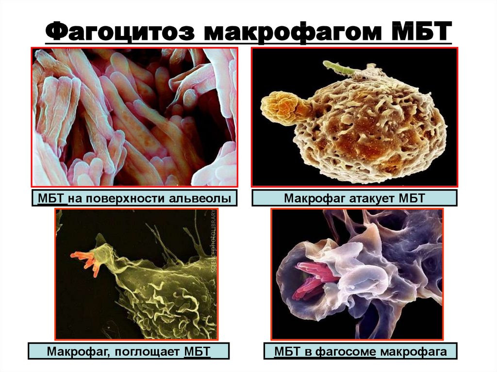 Макрофаги 2 3. Незавершенный фагоцитоз микобактерий туберкулеза. Микобактерии туберкулеза фагоц.