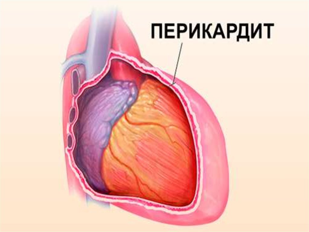 Перикардит. Ревматический перикардит. Гнойный перикардит сердце.