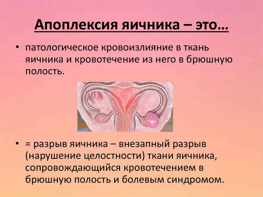 Причины разрыва яичника у женщин. Аппопреекция яйчников. Апоплексия яичника яичника. Подкапсульная апоплексия яичника.